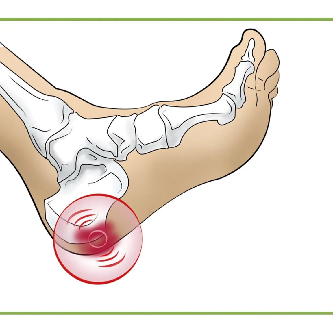 New Tempsl Talonnettes pour épine calcanéenne Modèle femme
